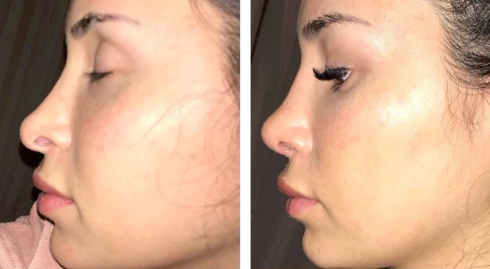 before & after photo of Revision Rhinoplasty