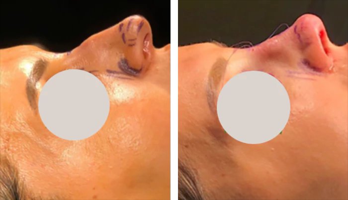 before & after photo of Rhinoplasty