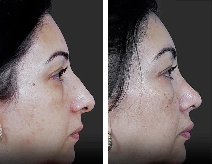 before & after photo of عملية تجميل الأنف