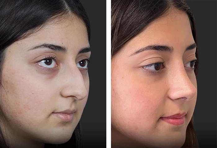 before & after photo of عملية تجميل الأنف