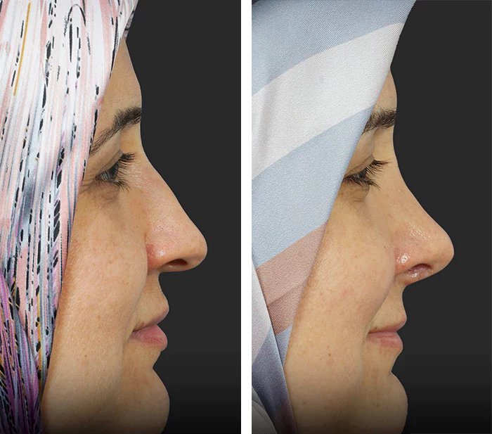 before & after photo of عملية تجميل الأنف