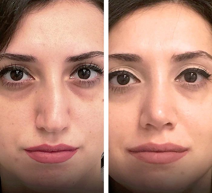 before & after photo of عملية تجميل الأنف