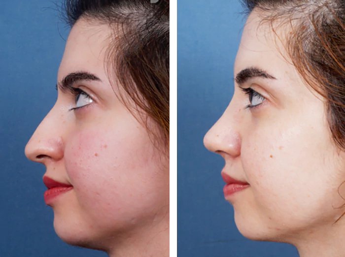 before & after photo of Rhinoplasty