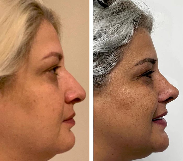 before & after photo of Rhinoplasty