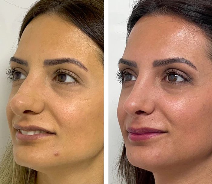 before & after photo of Rhinoplasty