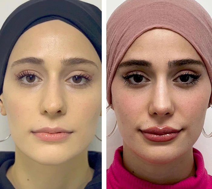 before & after photo of Rhinoplasty