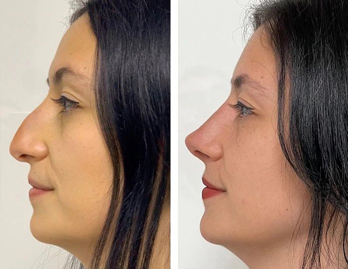 before & after photo of Rhinoplasty