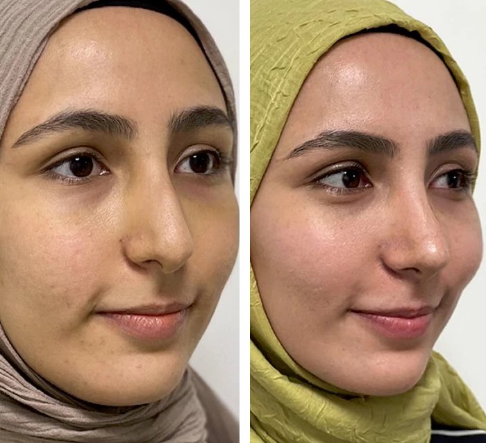 before & after photo of Rhinoplasty