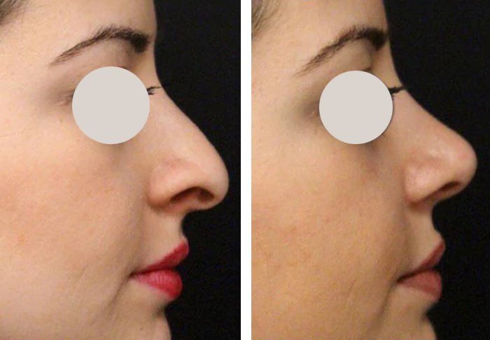 before & after photo of Otoplasty