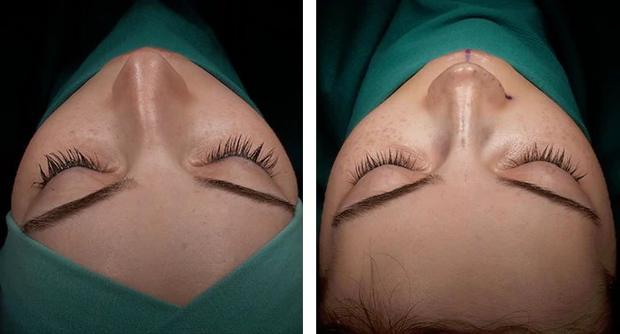 before & after photo of عملية تجميل الأنف