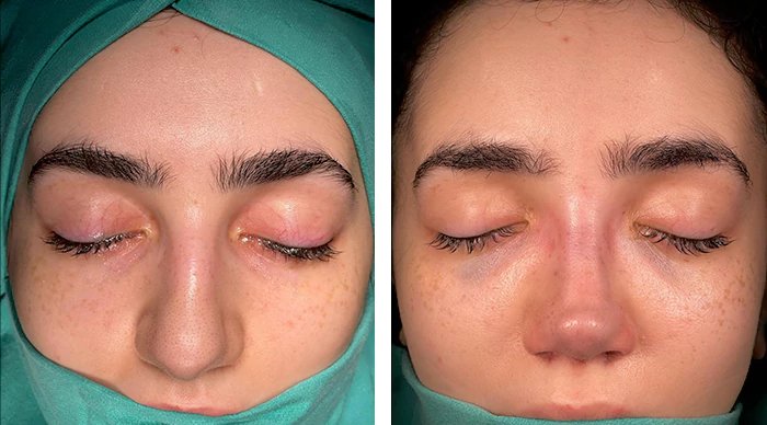 before & after photo of عملية تجميل الأنف