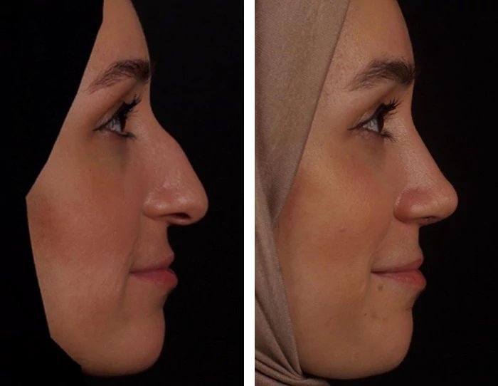 before & after photo of عملية تجميل الأنف