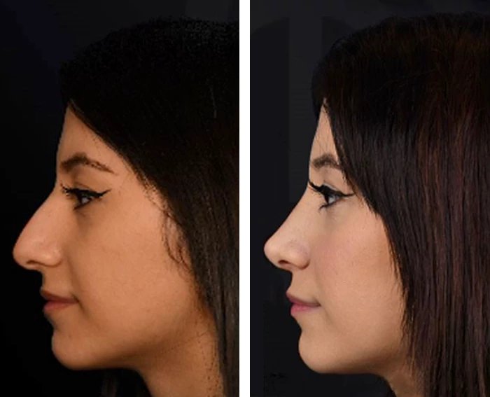 before & after photo of عملية تجميل الأنف