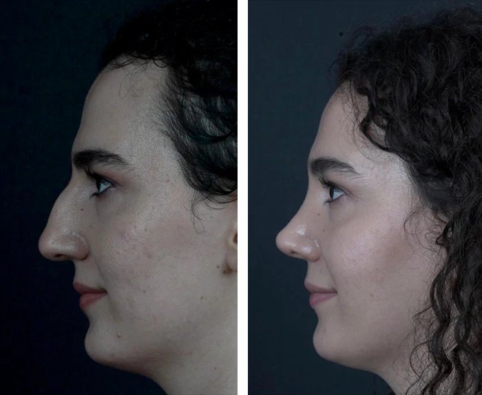 before & after photo of عملية تجميل الأنف