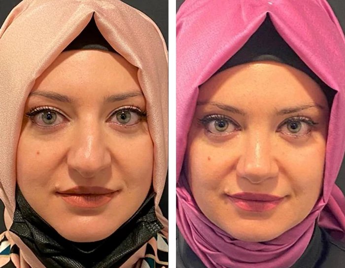 before & after photo of التخلص من الذقن المزدوج