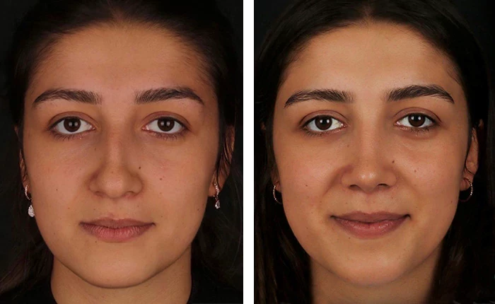 before & after photo of عملية تجميل الأنف