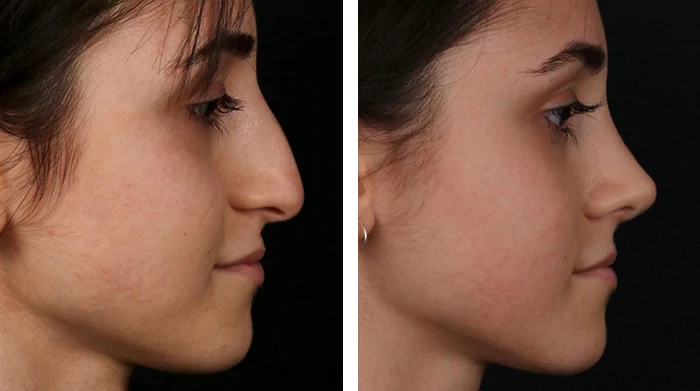 before & after photo of Rhinoplasty