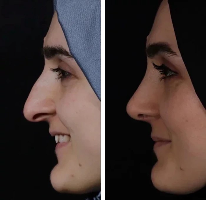 before & after photo of عملية تجميل الأنف