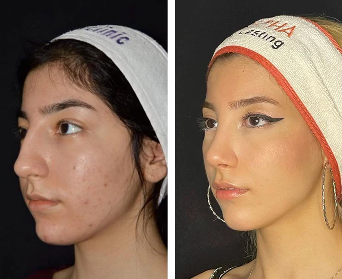 before & after photo of Rhinoplasty