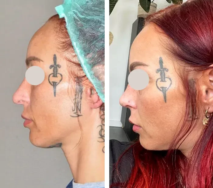 before & after photo of Rhinoplasty