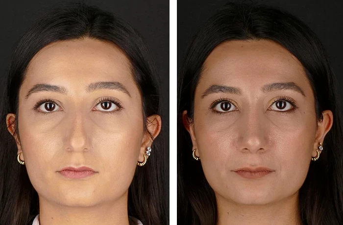 before & after photo of عملية الأنف الترميمية