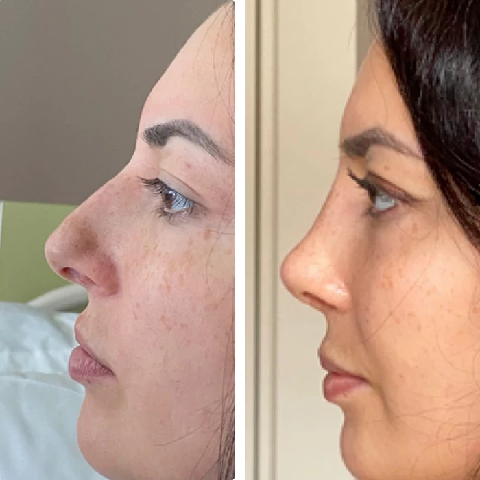 before & after photo of Rhinoplasty