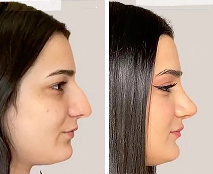 before & after photo of عملية تجميل الأنف