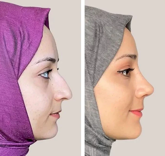 before & after photo of عملية تجميل الأنف