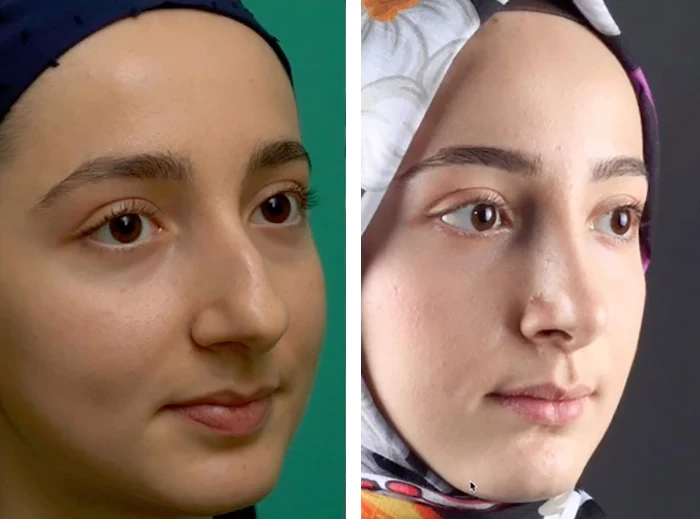 before & after photo of عملية تجميل الأنف