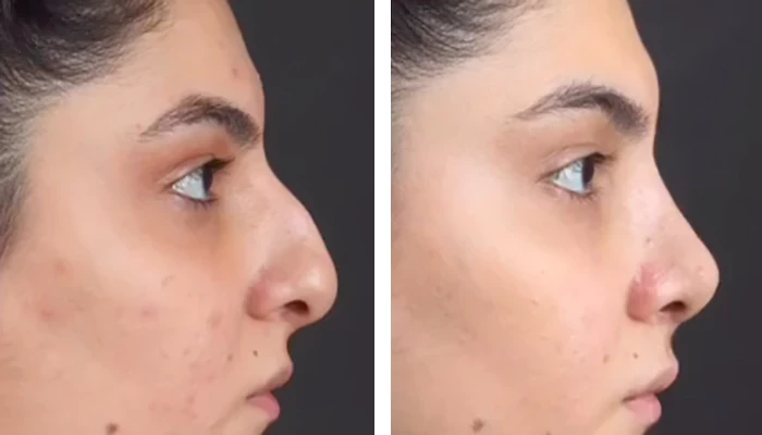 before & after photo of عملية تجميل الأنف