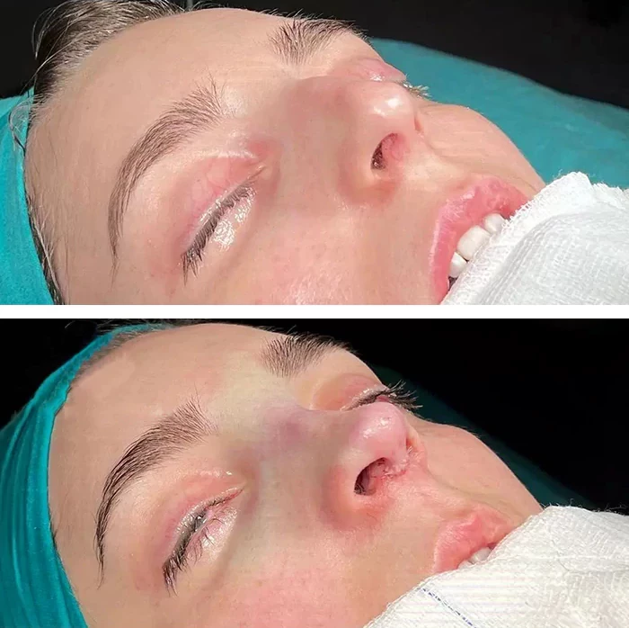 before & after photo of عملية تجميل الأنف