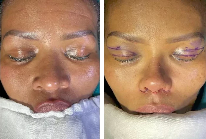 before & after photo of عملية تجميل الأنف