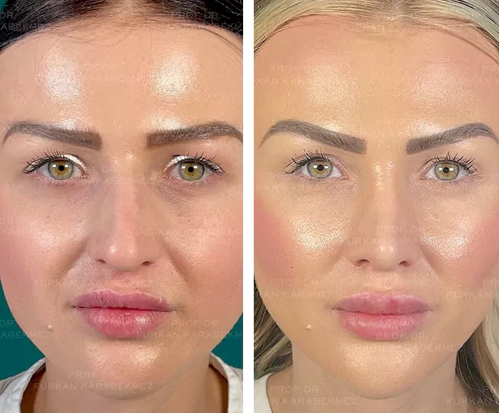 before & after photo of عملية تجميل الأنف