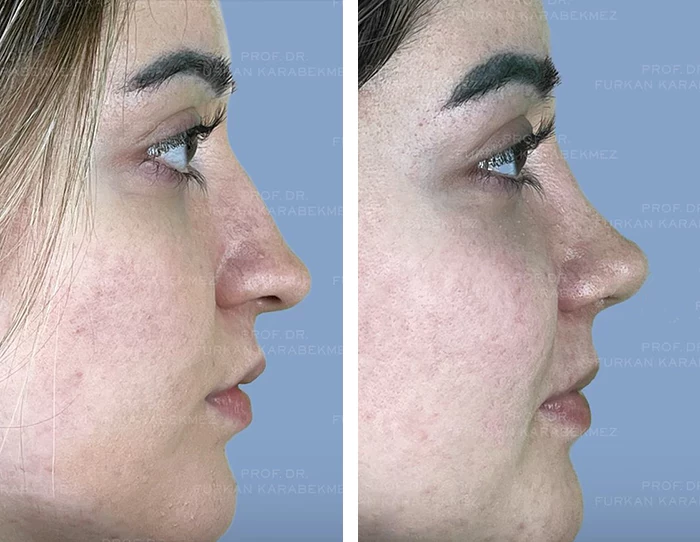 before & after photo of Rhinoplasty