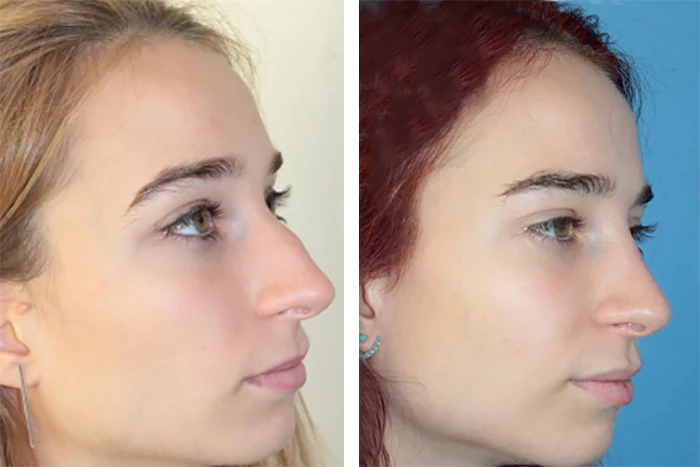 before & after photo of Rhinoplasty