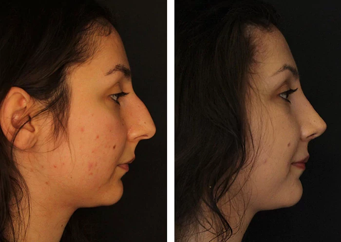 before & after photo of Otoplasty