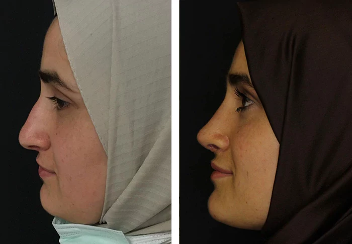 before & after photo of عملية تجميل الأذن