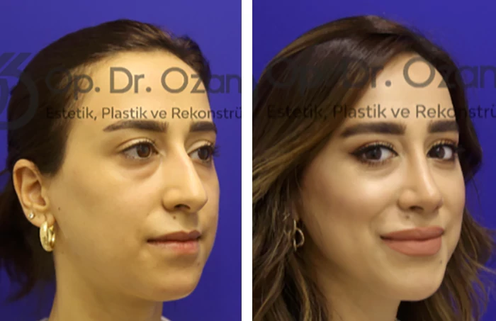 before & after photo of عملية تجميل الأنف