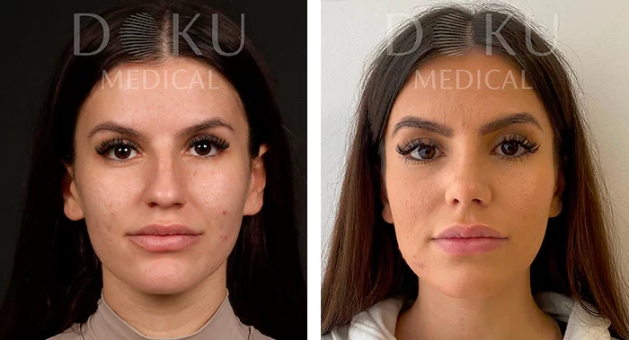 before & after photo of عملية تجميل الأنف