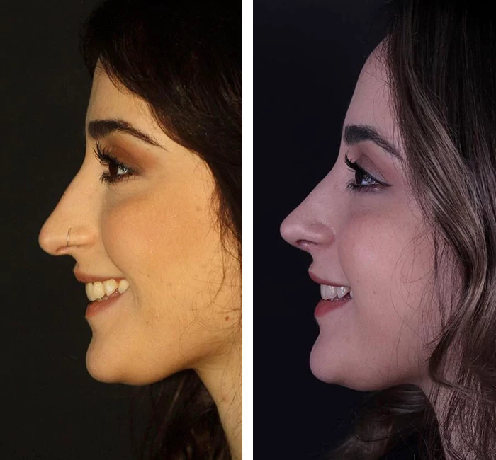 before & after photo of عملية تجميل الأنف