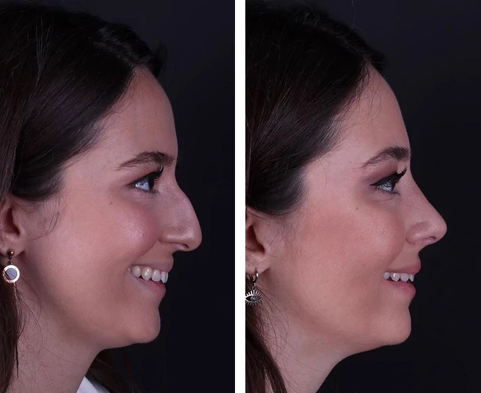 before & after photo of عملية تجميل الأنف