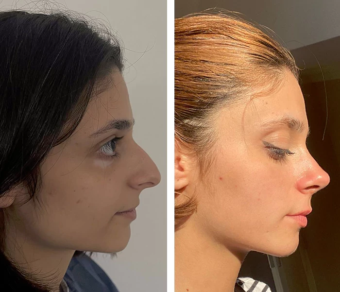 before & after photo of Rhinoplasty