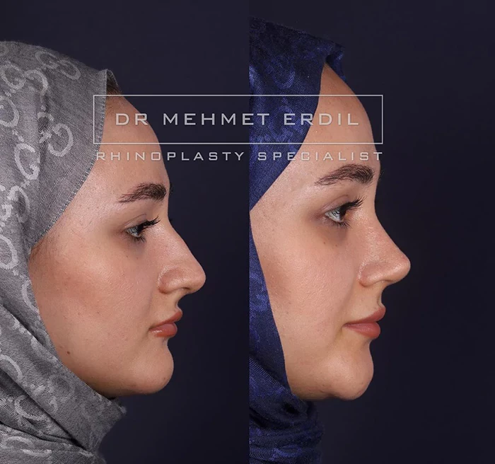 before & after photo of عملية تجميل الأنف