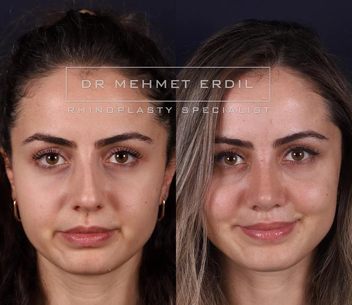 before & after photo of عملية تجميل الأنف