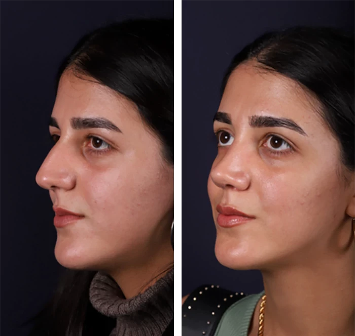 before & after photo of عملية تجميل الأنف