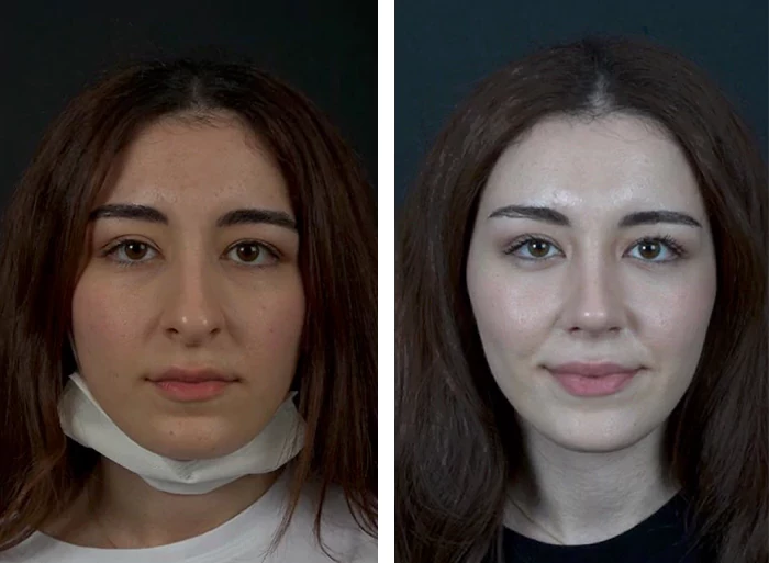 before & after photo of عملية تجميل الأنف