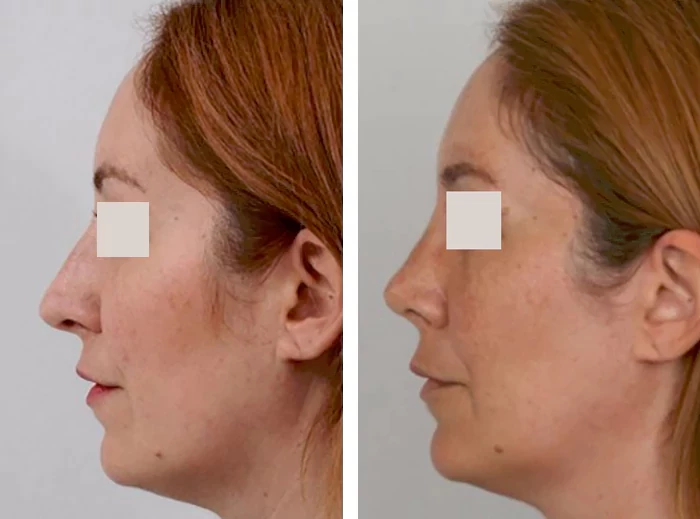 before & after photo of Rhinoplasty