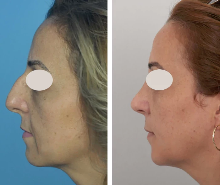 before & after photo of Rhinoplasty