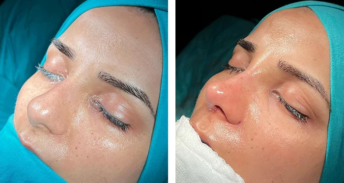 before & after photo of عملية تجميل الأنف