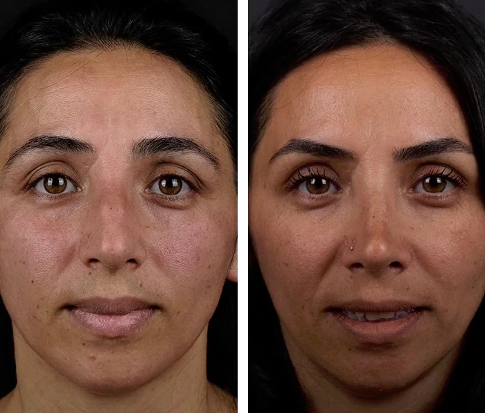 before & after photo of عملية تجميل الأنف